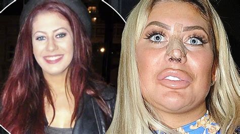 chloe ferry then and now|chloe ferry surgery timeline.